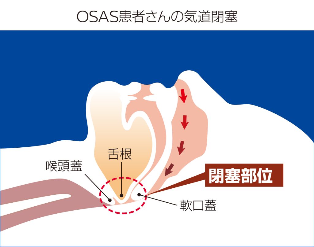 OSAS患者さんの気道閉塞（舌根沈下）